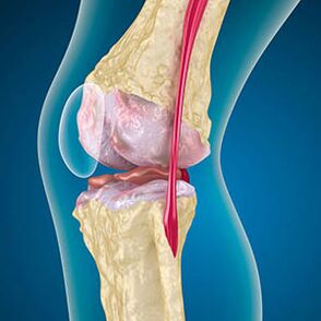 Excessive thigh muscle tension causes a knee pain