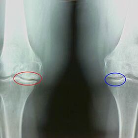 Knee arthrosis of the X -ray
