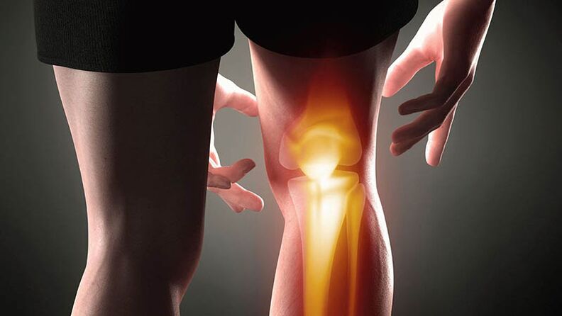 Knee arthrosis