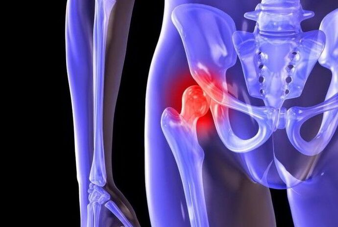 Pathological process in the hip joint with coxarthrosis